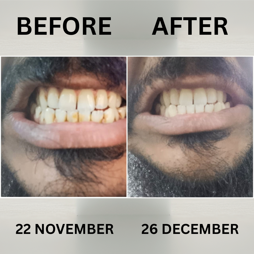 Snow Dent Teeth Whitening Powder