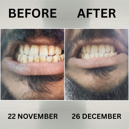 Snow Dent Teeth Whitening Powder